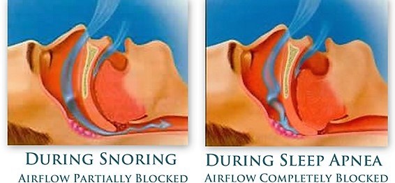 sleepapnea.snoring